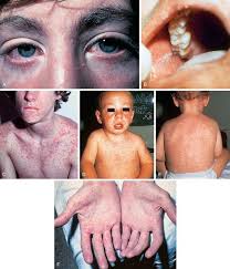 What does branny desquamation mean? Infectious Disease Obgyn Key