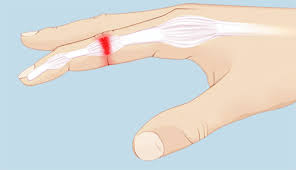 A hand surgeon will be able to diagnose whether the hand, finger or wrist is broken, sprained or bruised and whether symptoms, diagnosis and treatment of a sprain or strain in the hand or wrist. Sprained Finger Finger Sprain South Florida Hand Center