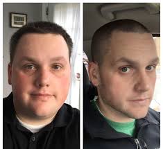 M 29 5 11 350 230 120 Lbs Down 1 Year Jawline Face Progress Progresspics