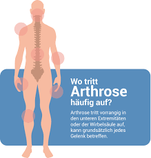 Arthrose Ratgeber I Ernahrung Behandlung
