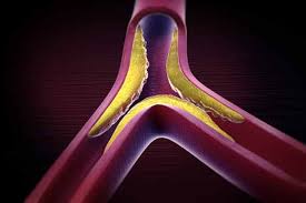 Yoga is an ancient discipline that shapes up the body and calms the mind through yoga asanas, pranayamas and meditation. 10 Easy Ways To Bring Down Triglyceride Levels In Your Body