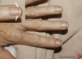 Role of the polycystic kidney disease 1 gene. The Hand Examination Stanford Medicine 25 Stanford Medicine