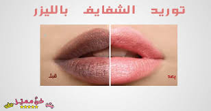 توريد الشفايف بالليزر تجربتي مع ليزر توريد الشفايف قبل و بعد