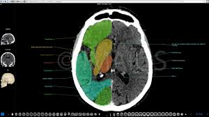 Brain Ct Anatomy Cerebral Lobes Ventricles Brain Anatomy Human Anatomy Chart Anatomy
