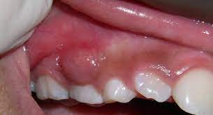 Most gum abscess is found at the end of a tooth's root and in between gums and teeth. Faq Abscess Discovery Pediatric Dentistry
