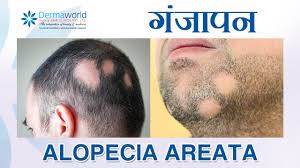 This form of treatment involves applying chemicals such as diphencyprone (dpcp), dinitrochlorobenzene (dncb) or squaric acid dibutyl ester (sadbe) to the scalp. à¤¬ à¤² à¤à¤¡ à¤¨ à¤— à¤œ à¤ªà¤¨ Alopecia Areata Balding In Patches How To Stop Them Dr Rohit Batra Youtube