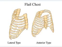 Image result for Flail Chest