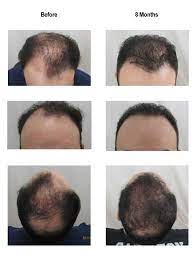 Before And After Of Recent Hair Transplant At 8 Months Hair Transplant Best Hair Transplant Hair Restoration