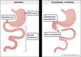 Type in english and press space(add space) to get converted to hindi. Congenital Malformations Of The Gastrointestinal Tract
