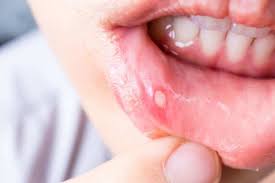 The place is so clean, and all the doctors as well as. Awas Ulser Mulut Berbahaya Lagi Lagi Yang Pakai Braces Maskulin