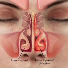Sulit untuk bernapas, suara berubah, dan setelah kamu selesai mandi kamu bisa merasakan hidungmu akan tersumbat lagi. Konka Hidung Membengkak Mungkin Itu Penyebab Hidung Sering Tersumbat Health Liputan6 Com