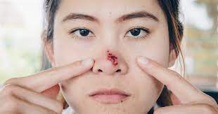 Was sie gegen eine entzündete nasenschleimhaut. Nasenherpes Ursache Behandlung Von Herpes In Der Nase