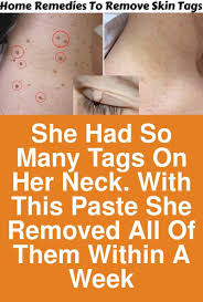 She Had So Many Tags On Her Neck With This Paste She Removed All Of Them Within A Week Today Skin Tag Removal Skin Tags Home Remedies Skin Care Home Remedies