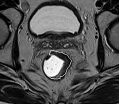 Magnetic resonance imaging in locally advanced rectal cancer: quantitative  evaluation of the complete response to neoadjuvant th