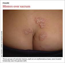 Are pimples on buttocks a sign of herpes, hiv or other stds? Recurrent Vesicular Rash Over The Sacrum Mdedge Family Medicine