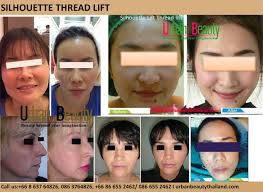 Possibilities of the eyebrow lift. Gold Thread Lift Thailand Skin Tighten Bangkok Urban Beauty Thailand