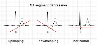 Paediatric Ecg Interpretation Litfl Medical Blog Ecg