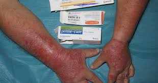 Image result for dermatitis contacta