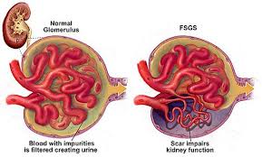 Fsgs Most Common Cause Of Nephrotic Syndrome In African Americans Starts With Focal Segmental Glomerulosclerosis Nephrotic Syndrome Urinary Tract Infection