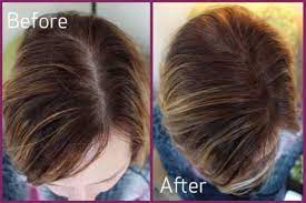 4 Natural Ways To Regrow Hair In 10 Days Positivemed Regrow Hair Naturally Regrow Hair Women Regrow Lost Hair