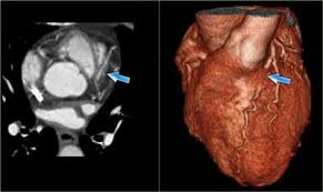 The number of superior septal arteries ranges from 1 to 10, with an average of 4.2, and the inferior one's ranges from 0 to 7, with an average of 2. The Radiology Assistant Coronary Anatomy And Anomalies