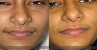 The cost of electrolysis hair removal can vary widely depending on a lot of factors. Unwanted Hair Removal Treatment In Vaishali Nagar Jaipur Id 8826474988