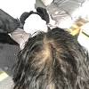 There are countless men and women suffering from hair loss due to health conditions such as ulcerative colitis and crohn's disease, whether it is a result of side effects from prednisone or the mesalamines, or even and most often from the direct result of malabsorption of nutrients, and this hair loss only serves to add to the stress of having to deal with this disease. 1