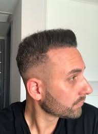 Transplantace Turecko vlastní zkušenost