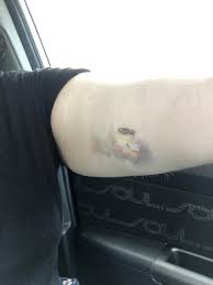 Nexplanon removal only takes a few minutes, but the process is a little longer than getting it put in. Healing Process Of Nexplanon Birth Control One Removed One Inserted Popping