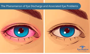 Image result for Eye Discharge