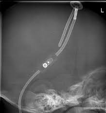 Radiologic Identification Of Vp Shunt Valves And Adjustment Pediatric Neurosurgery Leipzig