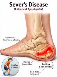 Image result for Calcaneal Apophysitis