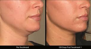 Sagging Skin And Turkey Neck Ask Dr White Carolina Laser And Cosmetic Center Winston Salem Nc Carolina Laser Cosmetic Center Winston Salem