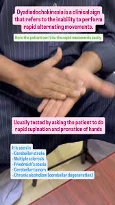 Image result for Rapid Alternating Movements