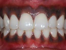 Tienes Encias Negras Te Contamos Las Causas Y Soluciones Clinica Dental Lekuona