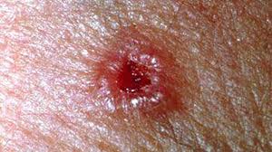 Subscribe to our free newsletters to receive latest health news and alerts to your email inbox. Skin Cancer Rash Itchiness And Symptoms