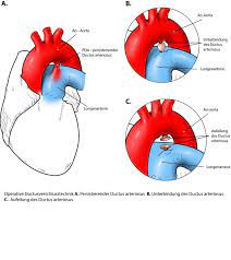 Das herz ist ein muskuläres hohlorgan, das als zentrale pumpstation des kreislaufes die transportvorgänge in allen blutgefäßen antreibt. Persistierender Ductus Arteriosus Ukm Klinik Fur Herz Und Thoraxchirurgie