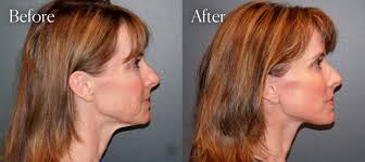 Facial Plastic Surgeon in Denver, CO