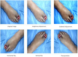 Image result for IDSA Diabetic Foot Wound Classification