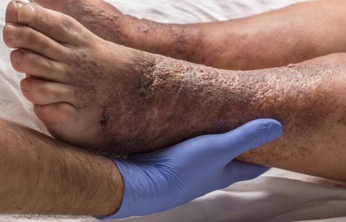 eczema