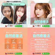 アイテムの自然癒着 整形手術 癒着 埋没法