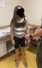 Weaning into the brace : r/scoliosis