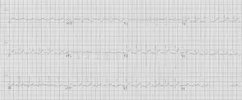 One must always rule out the most serious differential diagnosis, which is st elevation. Covid 19 And The Heart St Emlyn S Cardiology At St Emlyn S