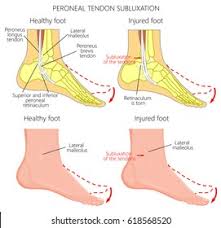 The fascia spans from the patellar tendon anteriorly to the midline of the popliteal fossa posteriorly. Vector Illustration Peroneal Tendon Injuries Peroneal Stock Vector Royalty Free 618568520
