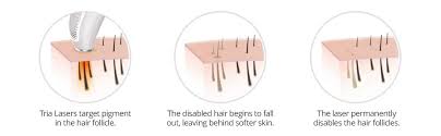 The tria laser for permanent reduction in hair regrowth precision, you won't be able to unlock it with. Amazon Com Tria Beauty Precision Hair Removal Laser For Women And Men Premium Beauty