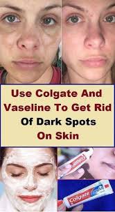 Ways To Get Rid Of Brown Spots On Face Brownspotsonteeth Brownagespots Raisedbrownspotsonface Brownspotsr In 2020 Dark Spots On Skin Skin Spots Brown Spots On Face