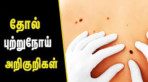 Cancer symptoms vary depending on many factors, such as the cancer type, stage, size and location. Skin Cancer Symptoms Skin Care Tips In Tamil Tamil Health Beauty Tips Youtube
