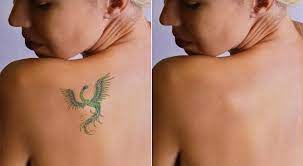 Ce qu'il faut savoir avant de se faire tatouer. Enlever Un Tatouage Au Laser Sante Magazine