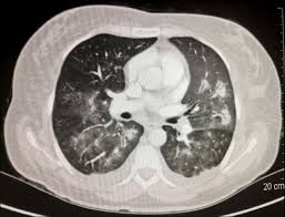 Ct scans show more detail than. Scielo Brasil Pulmonary Kaposi S Sarcoma In A Female Patient Case Report Pulmonary Kaposi S Sarcoma In A Female Patient Case Report