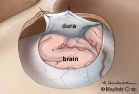 pin on brain surgery
